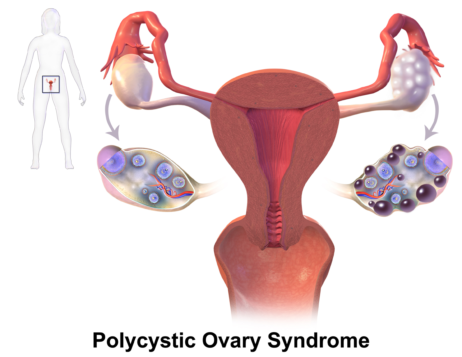 Featured image for “Understanding Polycystic Ovary Syndrome (PCOS): A Comprehensive Guide”
