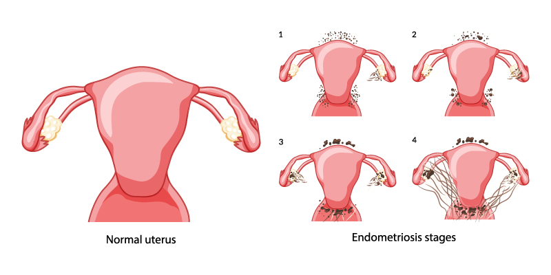 Featured image for “Understanding Endometriosis: What Every Woman Should Know”